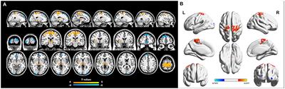 Altered Regional Homogeneity in Patients With Congenital Blindness: A Resting-State Functional Magnetic Resonance Imaging Study